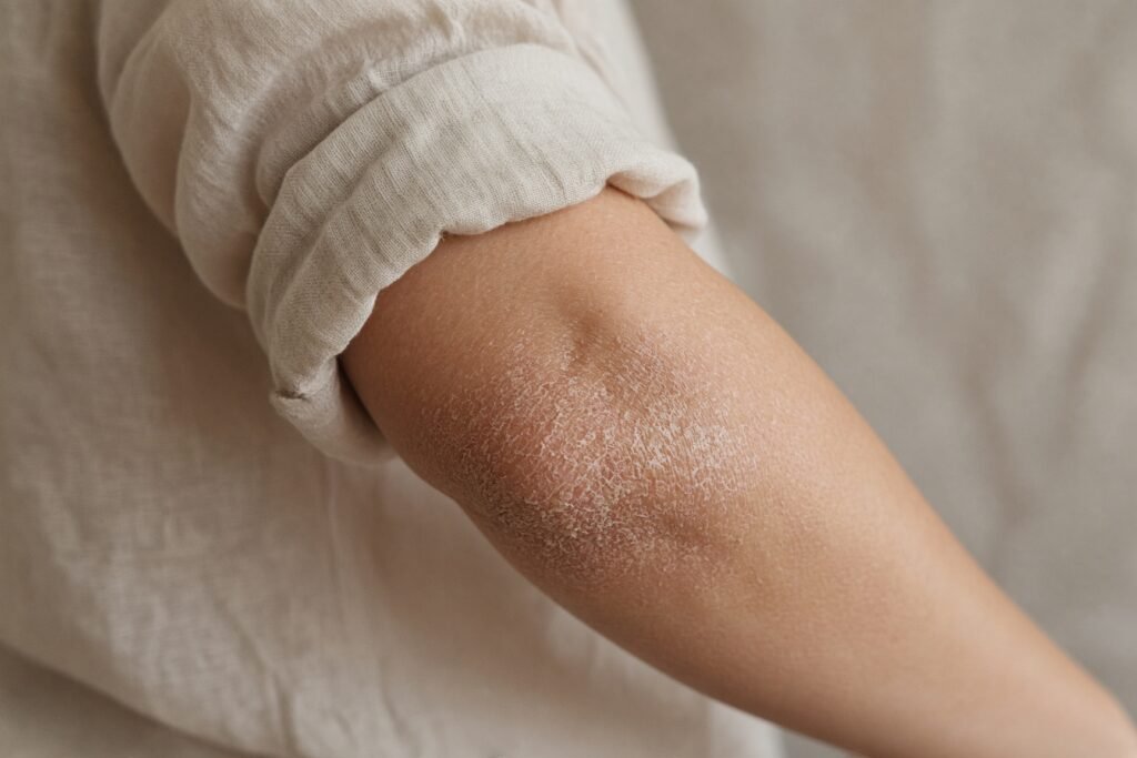 Psoriasis Treatment at a Private GP: When Your Skin Needs More Than a Quick Appointment