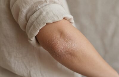 Psoriasis Treatment at a Private GP: When Your Skin Needs More Than a Quick Appointment